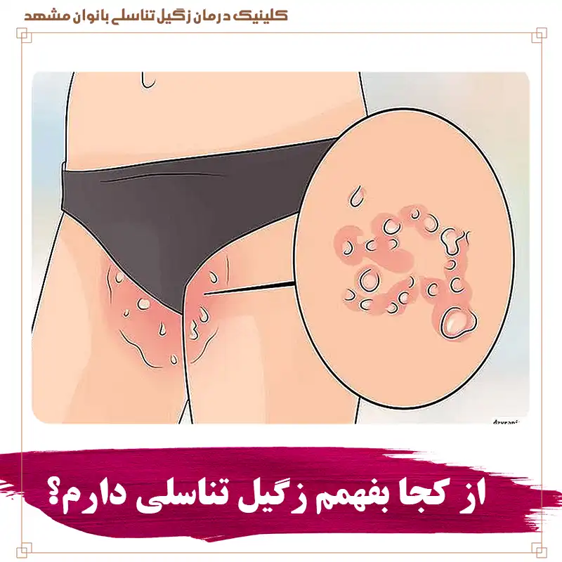 زگیل تناسلی و انجام آزمایش HPV